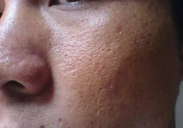 战痘｜史上最全”战痘“解答50+合集！