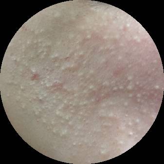 战痘｜史上最全”战痘“解答50+合集！