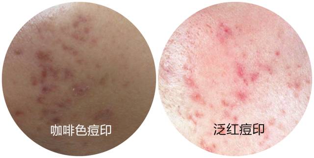 战痘｜史上最全”战痘“解答50+合集！