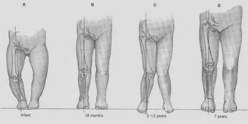 初中孩子腿不直怎么矫正腿型,17岁孩子腿不直怎么矫正
