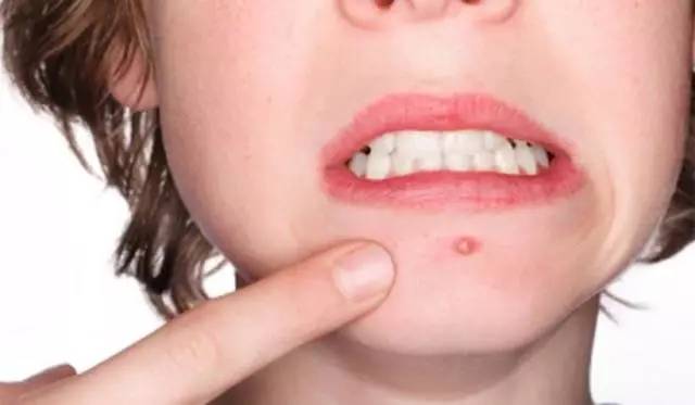 战痘｜史上最全”战痘“解答50+合集！