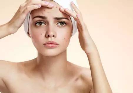 战痘｜史上最全”战痘“解答50+合集！