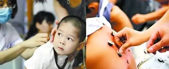 三伏贴能自制吗？孩子能贴吗？选择哪些穴位贴？贵医附院专家为你详细解答