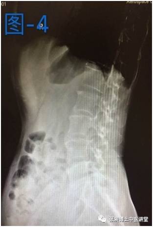 小针刀治疗脊柱侧弯,脊柱侧弯小针刀可以治愈吗