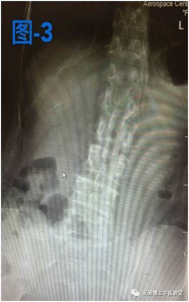 小针刀治疗脊柱侧弯,脊柱侧弯小针刀可以治愈吗