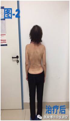 小针刀治疗脊柱侧弯,脊柱侧弯小针刀可以治愈吗