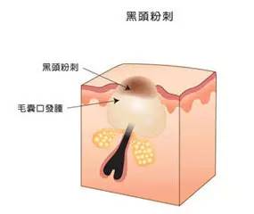 战痘｜史上最全”战痘“解答50+合集！