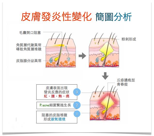 战痘｜史上最全”战痘“解答50+合集！