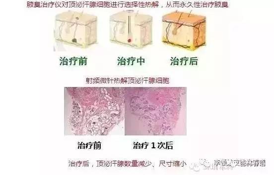 腋臭治疗黄金微针和微创手术对比,黄金微针微创腋臭手术能根治吗