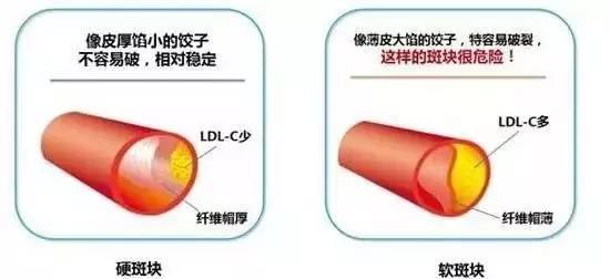 冠心病我们怎样才能预防心得体会,冠心病新指南变化内容