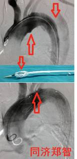 来了！建军节特别行动之探秘“主动脉夹层”