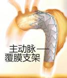 来了！建军节特别行动之探秘“主动脉夹层”