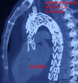 来了！建军节特别行动之探秘“主动脉夹层”