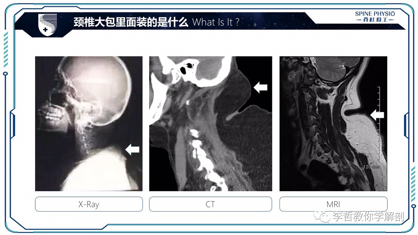 24度颈部大包怎么去除,颈后大包通过训练消除