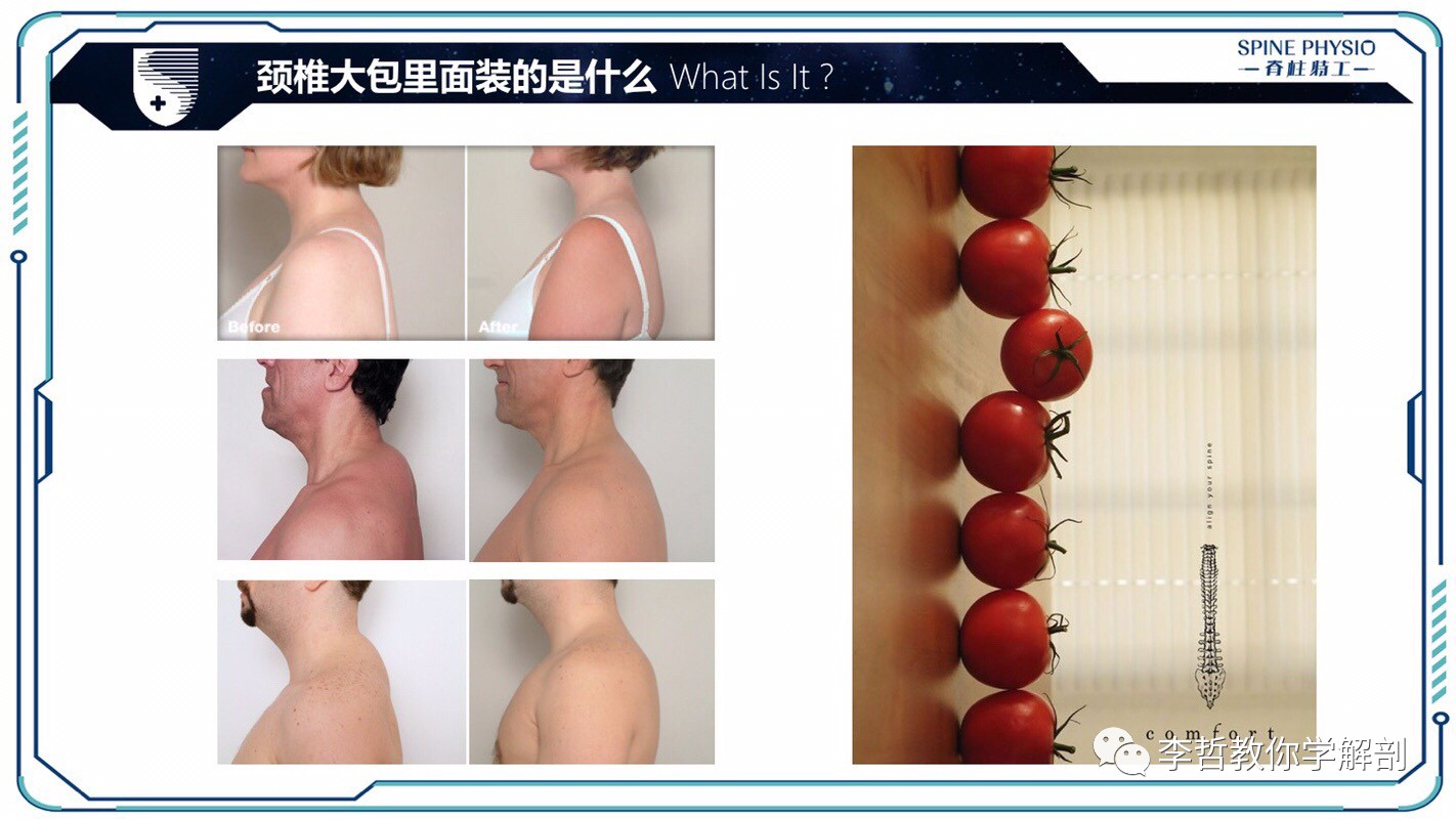 24度颈部大包怎么去除,颈后大包通过训练消除