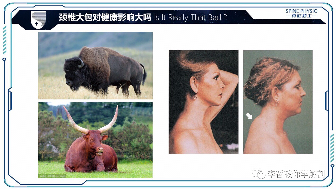 24度颈部大包怎么去除,颈后大包通过训练消除