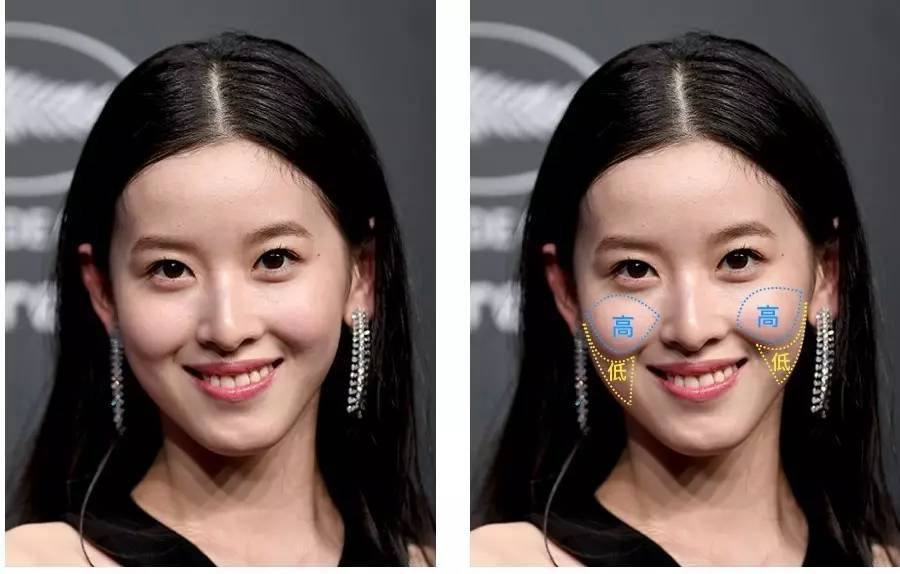 泪沟法令纹颈纹显老怎么办,改善泪沟法令纹全脸提升的方法