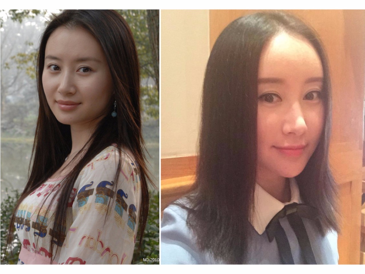 泪沟法令纹颈纹显老怎么办,改善泪沟法令纹全脸提升的方法