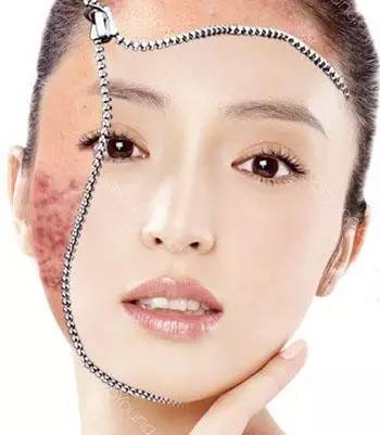 祛痘印用什么激光祛痘好,激光祛痘印痘坑能彻底去掉痘痘吗