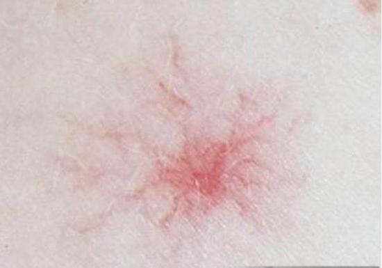 皮肤长红痣得了肝病医生先别慌,身体长红痣肝病的早期症状有哪些