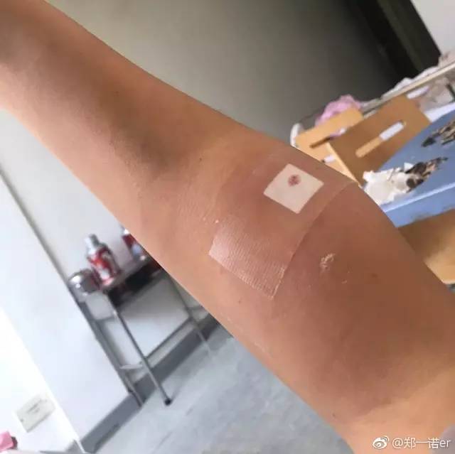 福寿螺寄生虫真实案,女子吃福寿螺感染寄生虫