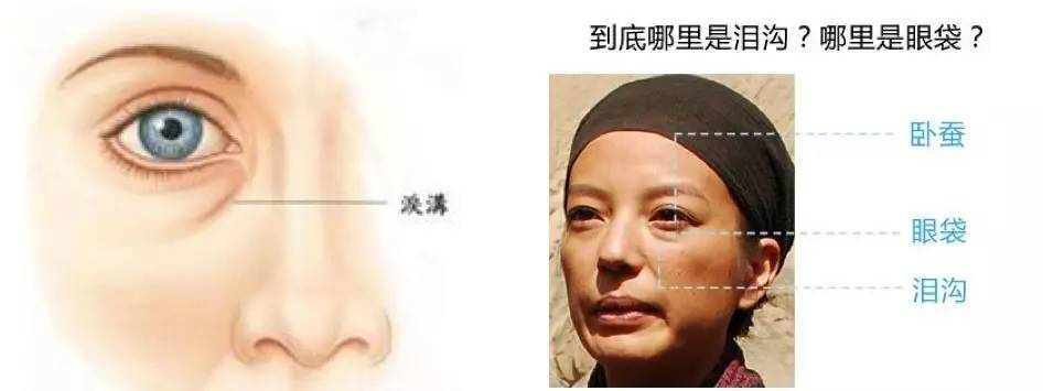 泪沟法令纹颈纹显老怎么办,改善泪沟法令纹全脸提升的方法