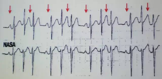 郭继鸿心电图学教程,郭继鸿异常心电图