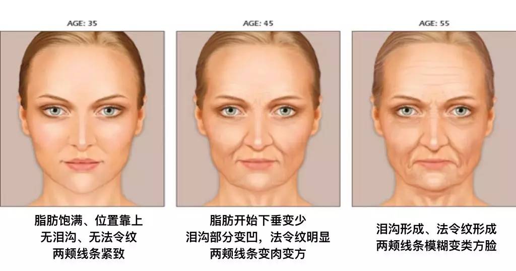 泪沟法令纹颈纹显老怎么办,改善泪沟法令纹全脸提升的方法
