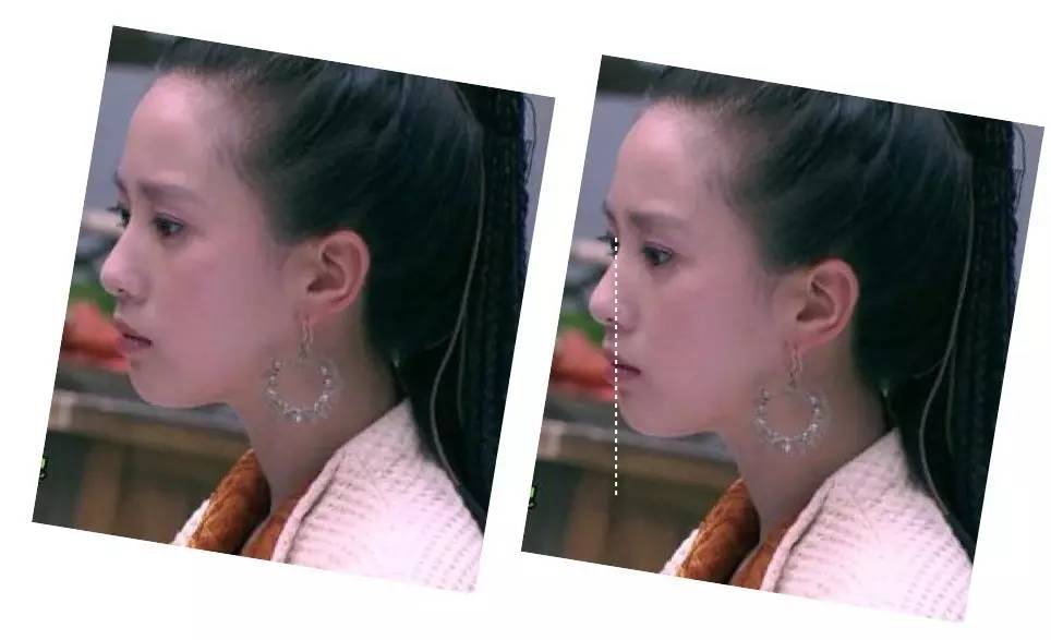 泪沟法令纹颈纹显老怎么办,改善泪沟法令纹全脸提升的方法