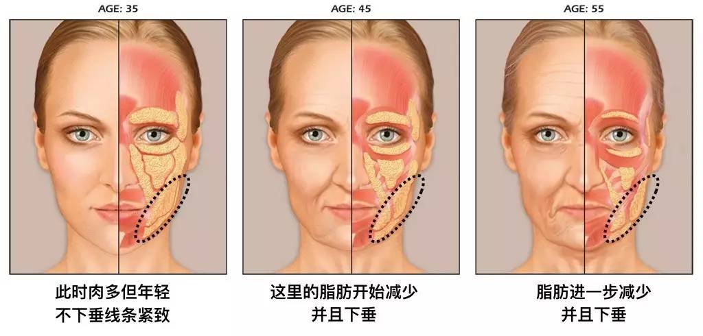 泪沟法令纹颈纹显老怎么办,改善泪沟法令纹全脸提升的方法