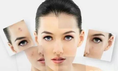 祛痘小窍门掌握了就不会有烦恼,最全祛痘攻略快速祛痘不留痕