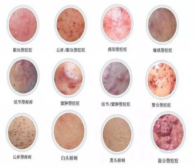 祛痘印用什么激光祛痘好,激光祛痘印痘坑能彻底去掉痘痘吗