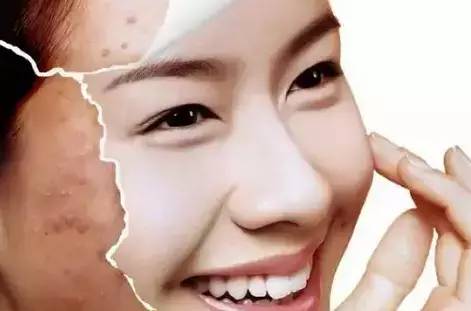 祛痘印用什么激光祛痘好,激光祛痘印痘坑能彻底去掉痘痘吗