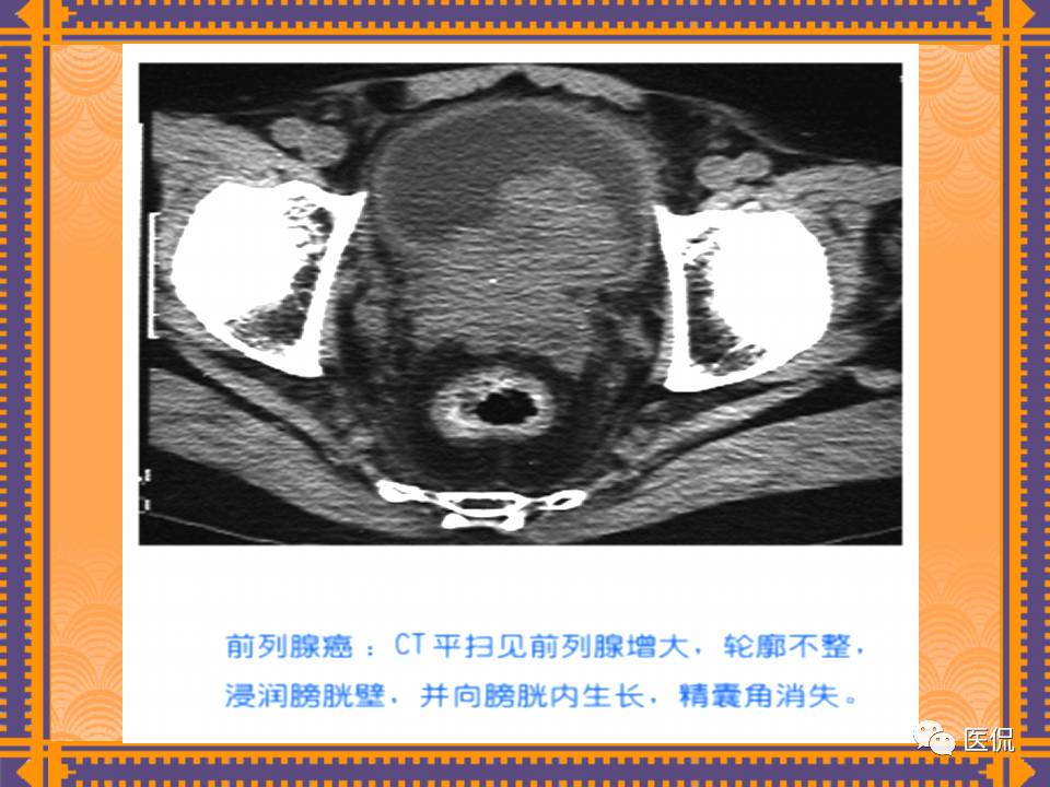 生殖系统疾病影像学诊断医学影像精品PPT