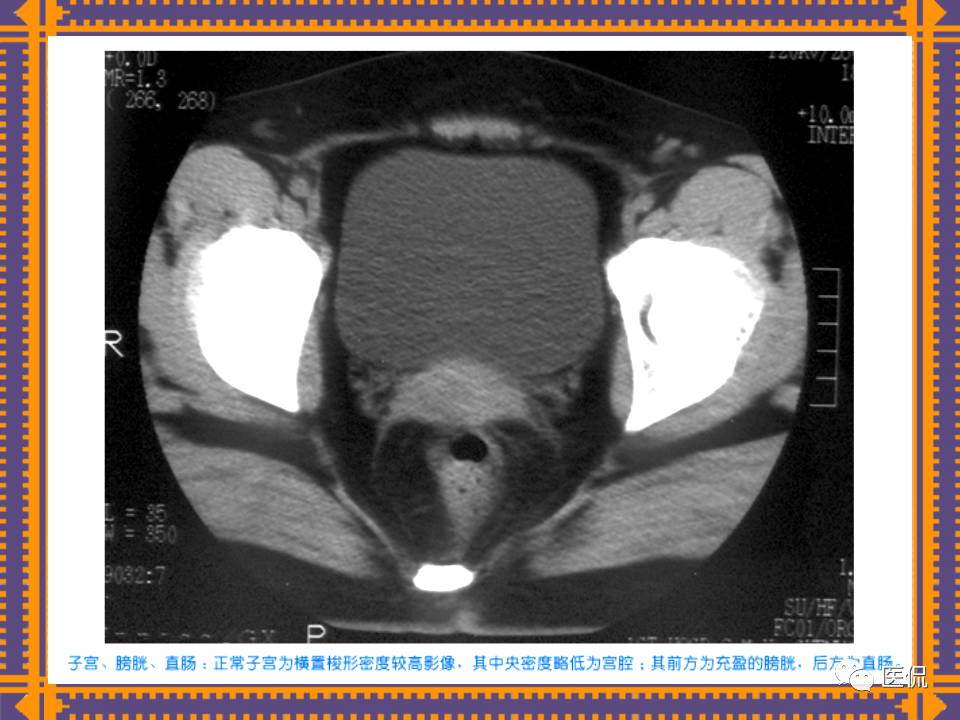 生殖系统疾病影像学诊断医学影像精品PPT