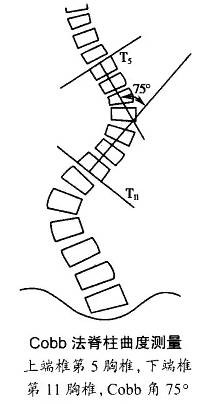 每天100个引体向上纠正脊柱侧弯,脊柱侧弯自我矫正方法图解