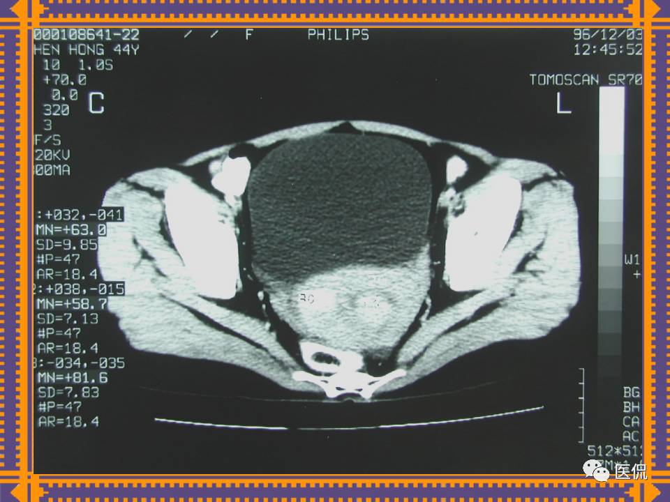 生殖系统疾病影像学诊断医学影像精品PPT