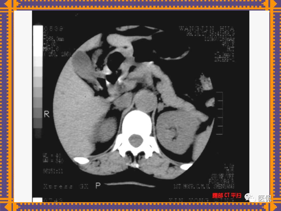 生殖系统疾病影像学诊断医学影像精品PPT