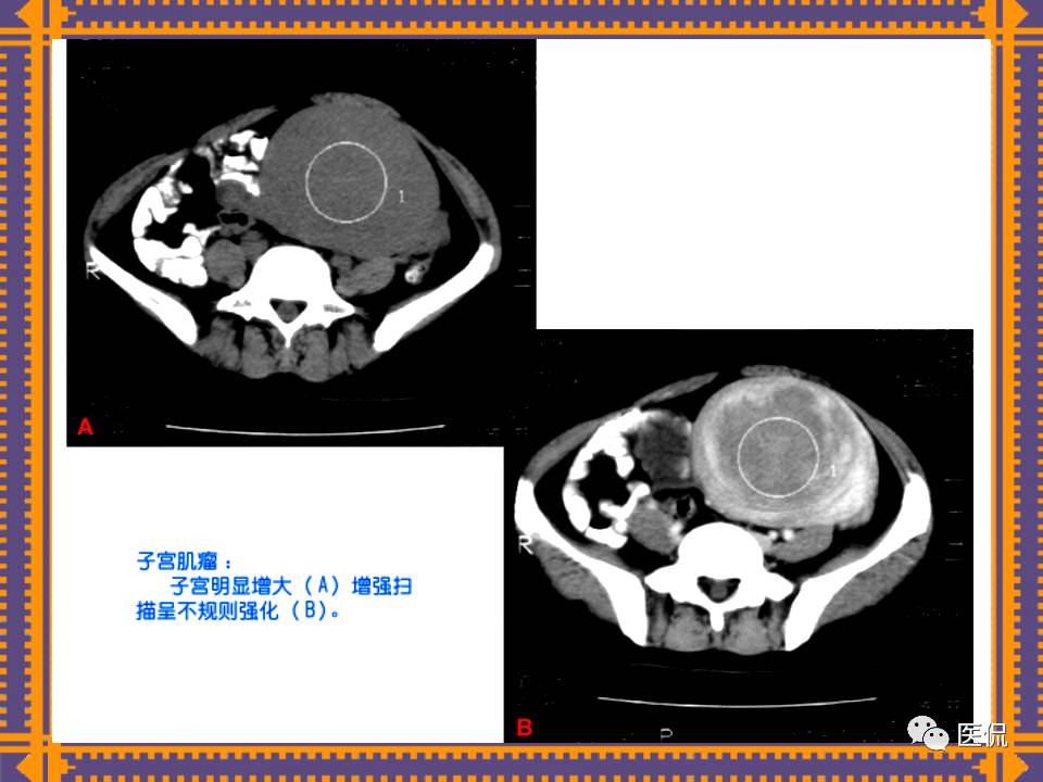 生殖系统疾病影像学诊断医学影像精品PPT