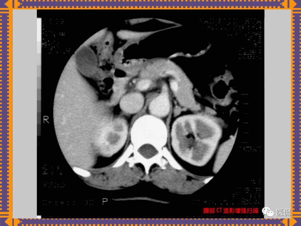 生殖系统疾病影像学诊断医学影像精品PPT