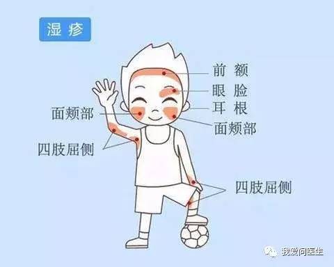 摆脱湿疹,消除湿疹特效药