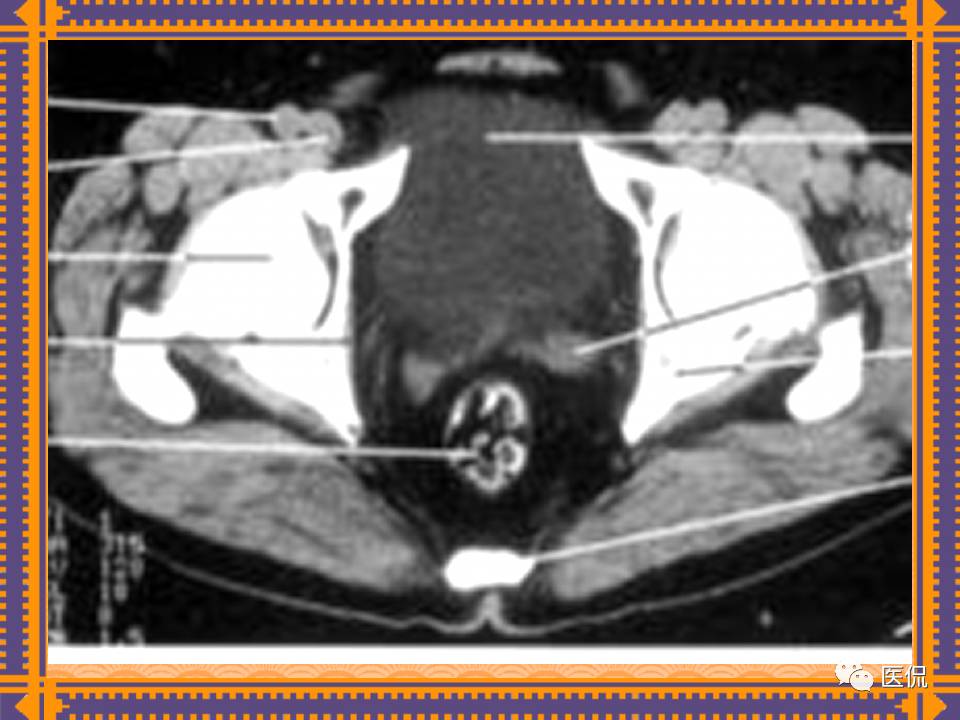 生殖系统疾病影像学诊断医学影像精品PPT