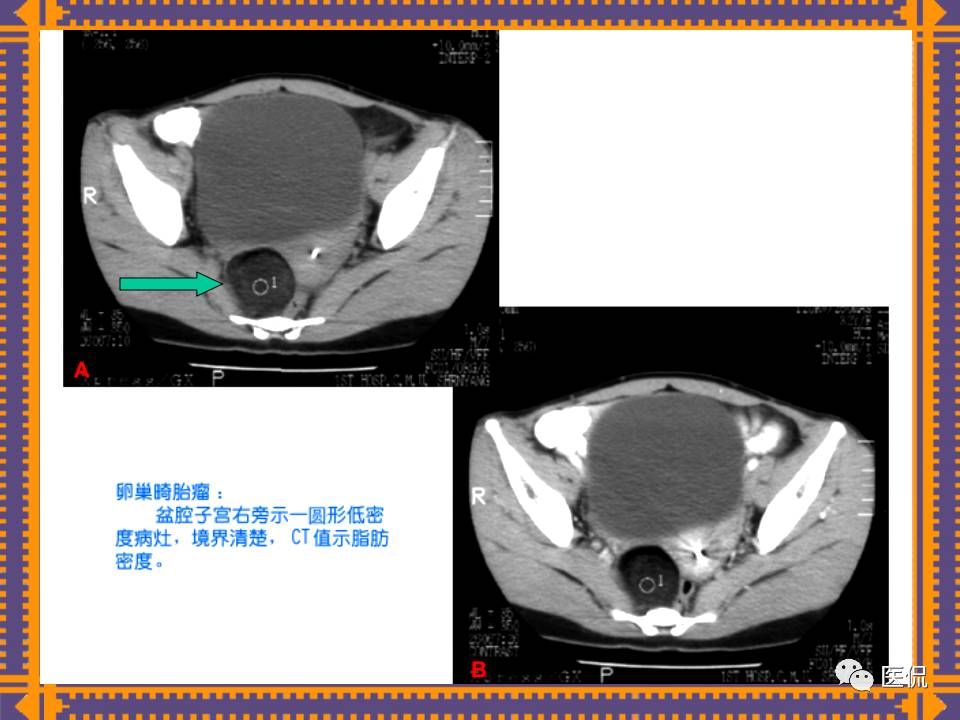生殖系统疾病影像学诊断医学影像精品PPT