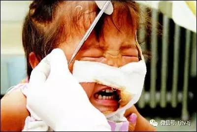 如何给自己的伤口换药,伤口自己在家换药都需要什么