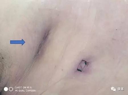 胸腔镜微创能切除多大的肿瘤,胸腔镜切除肿瘤