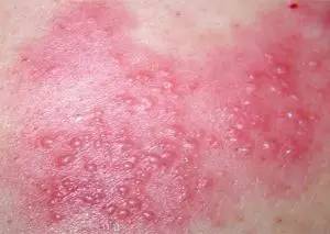 「二院技术」出*麻疹荨**满脸红痕这些皮肤病会“秋后算账”