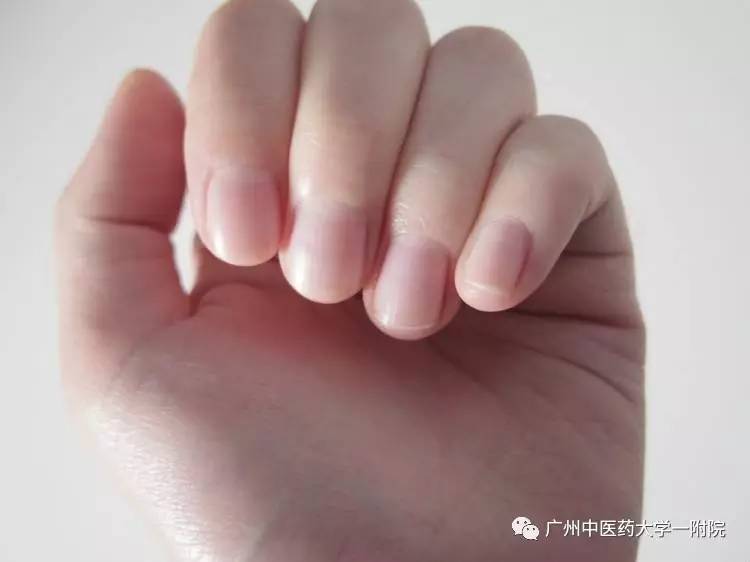 指甲薄软容易断是肝血不足吗,补肝血能治疗灰指甲吗