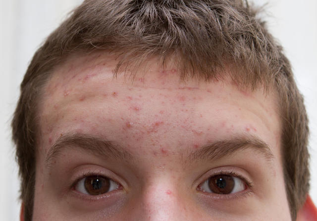 多年的痘痘被彻彻底底解决,困扰多年的痘痘终于好了