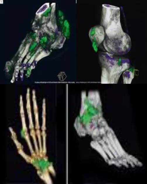 帮您对抗痛风和高尿酸