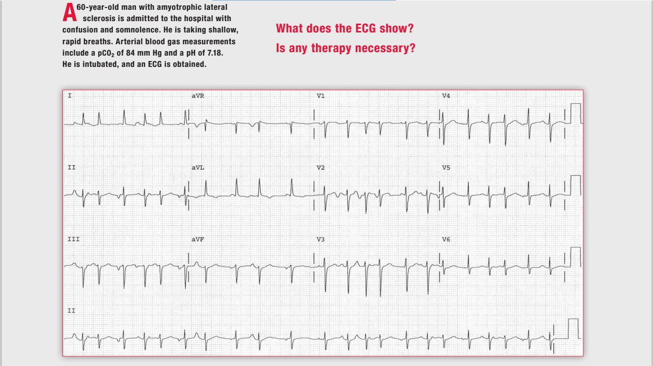 「读心有术」164期:这种多源性房速需要治疗吗?